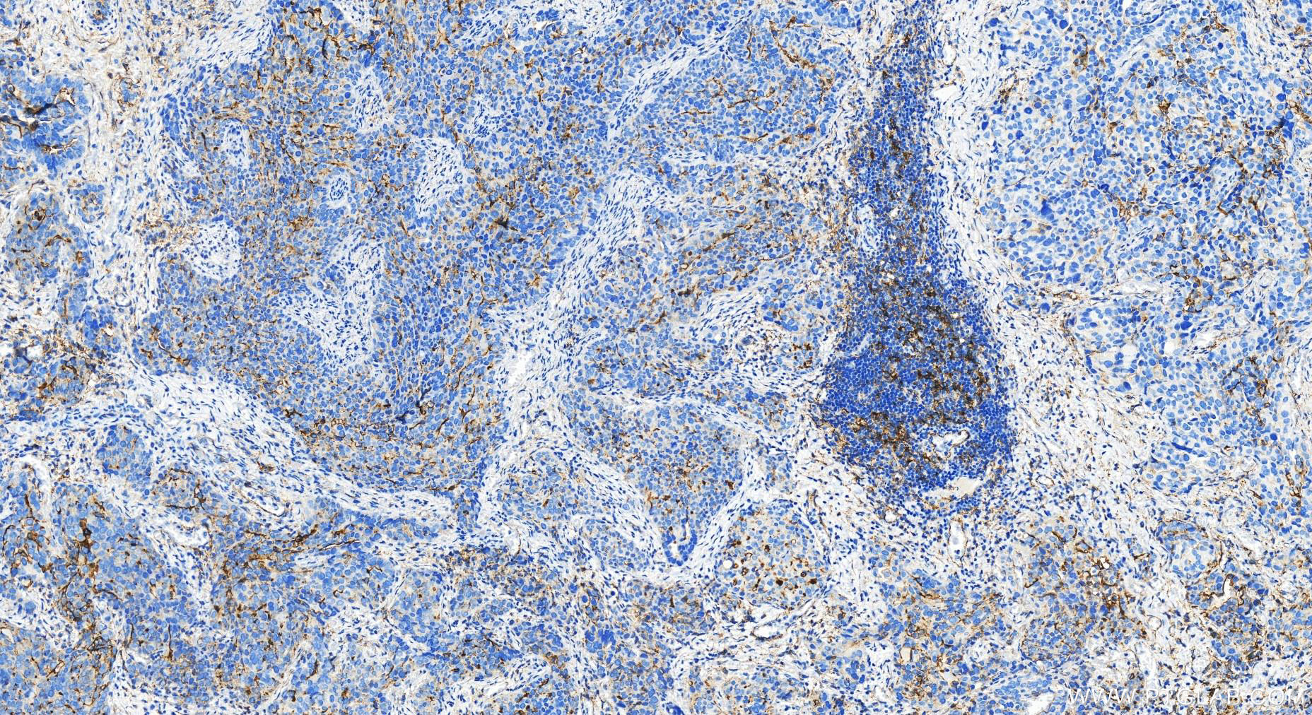 Immunohistochemistry (IHC) staining of human ovary cancer tissue using ICAM-1/CD54 Polyclonal antibody (30806-1-AP)