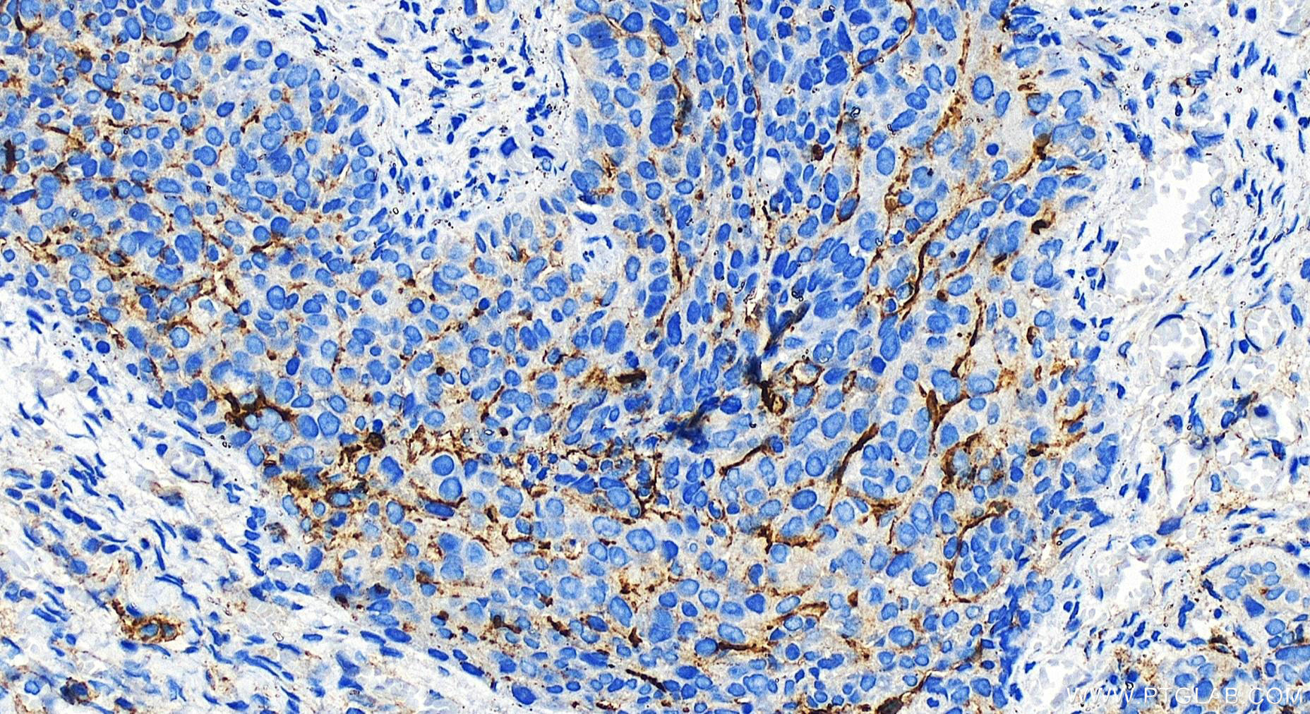 Immunohistochemistry (IHC) staining of human ovary cancer tissue using ICAM-1/CD54 Polyclonal antibody (30806-1-AP)