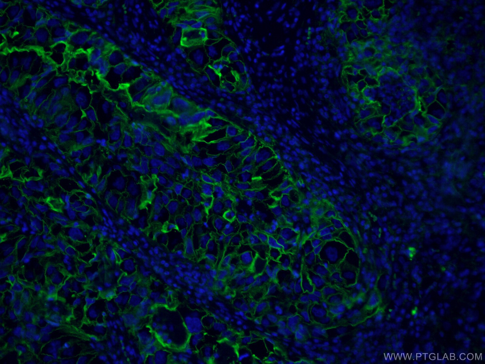 Immunofluorescence (IF) / fluorescent staining of human lung cancer tissue using ICAM-1 Monoclonal antibody (60299-1-Ig)