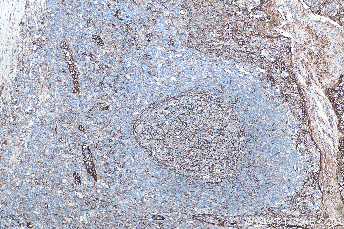 Immunohistochemistry (IHC) staining of human tonsillitis tissue using ICAM-1/CD54 Monoclonal antibody (60299-1-Ig)