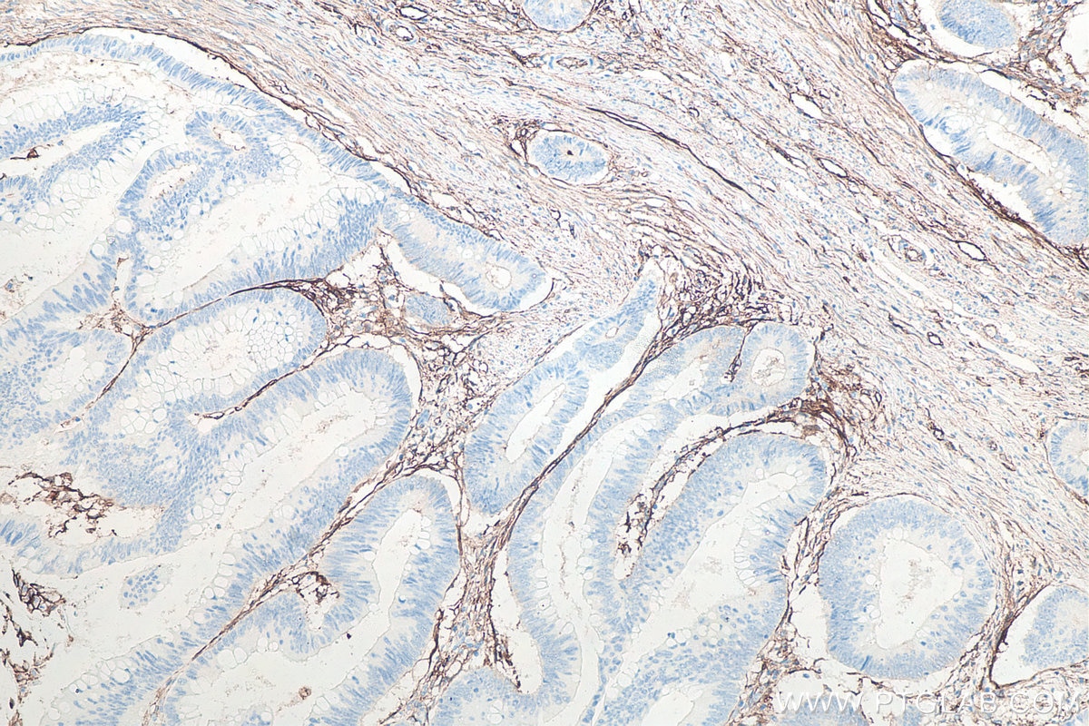 Immunohistochemistry (IHC) staining of human colon cancer tissue using ICAM-1/CD54 Monoclonal antibody (60299-1-Ig)