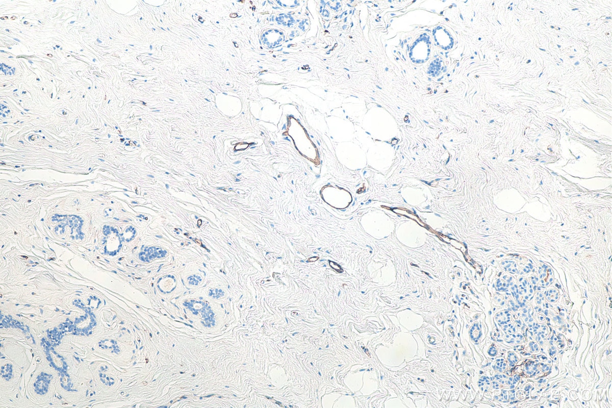 Immunohistochemistry (IHC) staining of human breast cancer tissue using ICAM-1/CD54 Monoclonal antibody (60299-1-Ig)