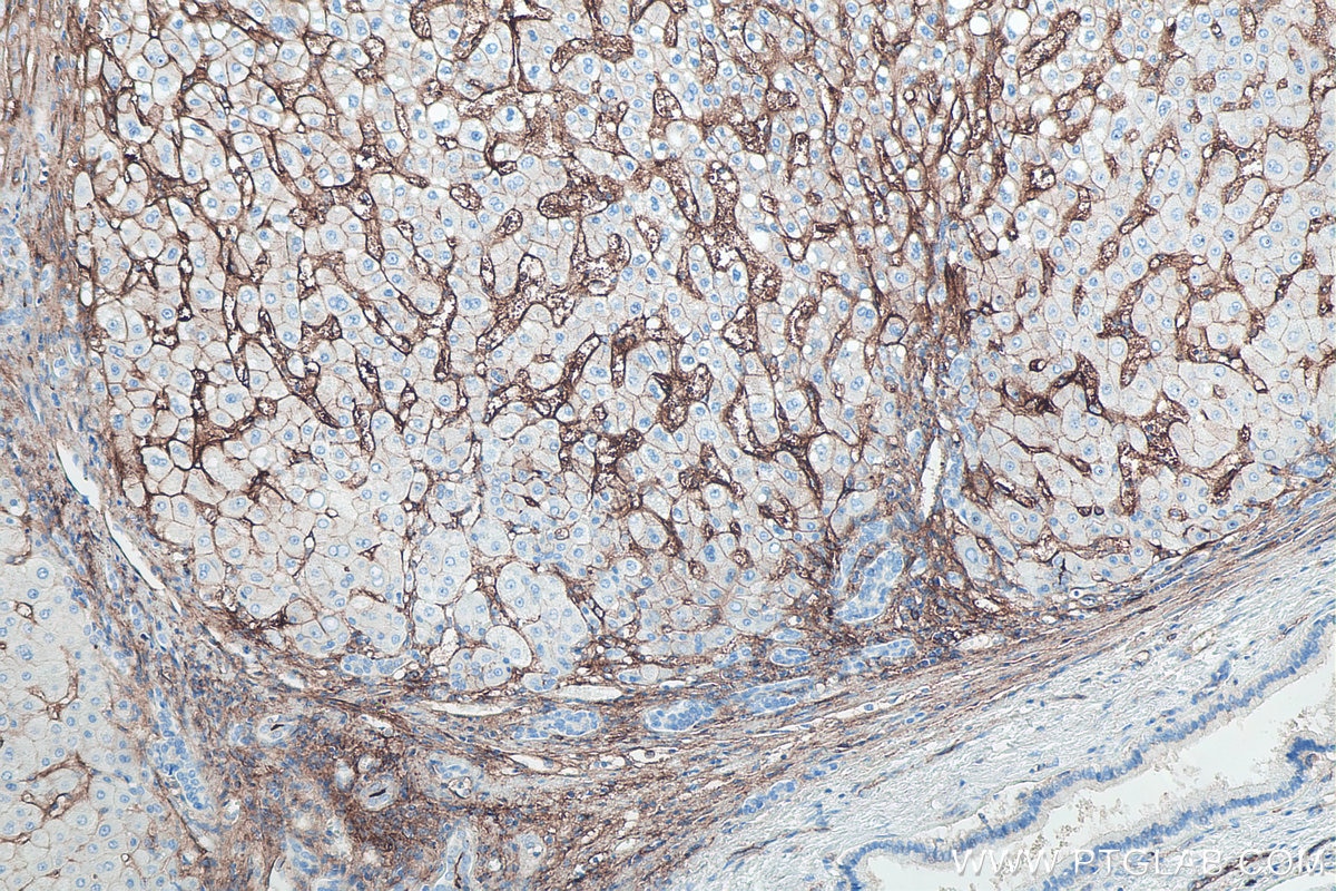 Immunohistochemistry (IHC) staining of human liver cancer tissue using ICAM-1/CD54 Monoclonal antibody (60299-1-Ig)