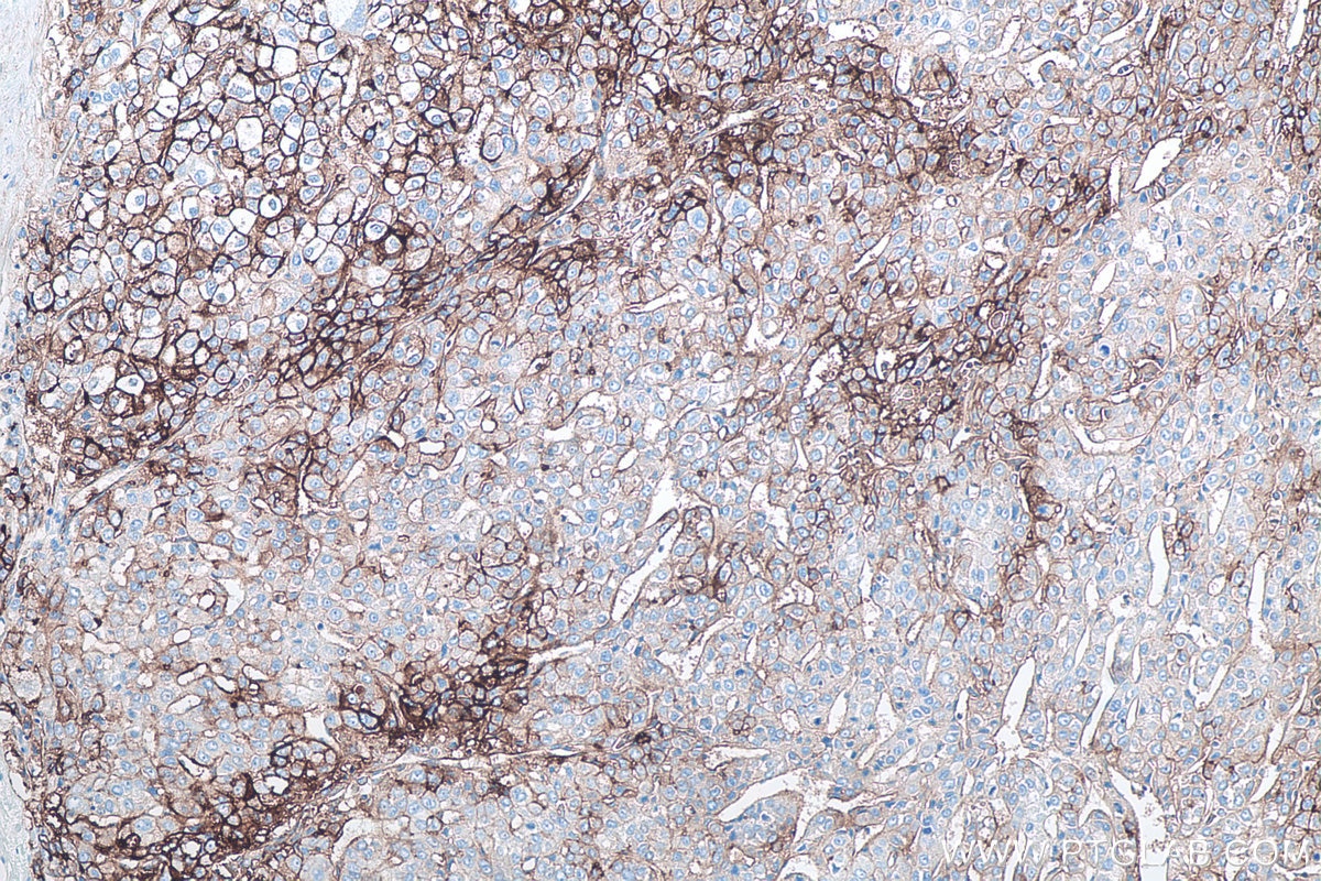 Immunohistochemistry (IHC) staining of human liver cancer tissue using ICAM-1/CD54 Monoclonal antibody (60299-1-Ig)
