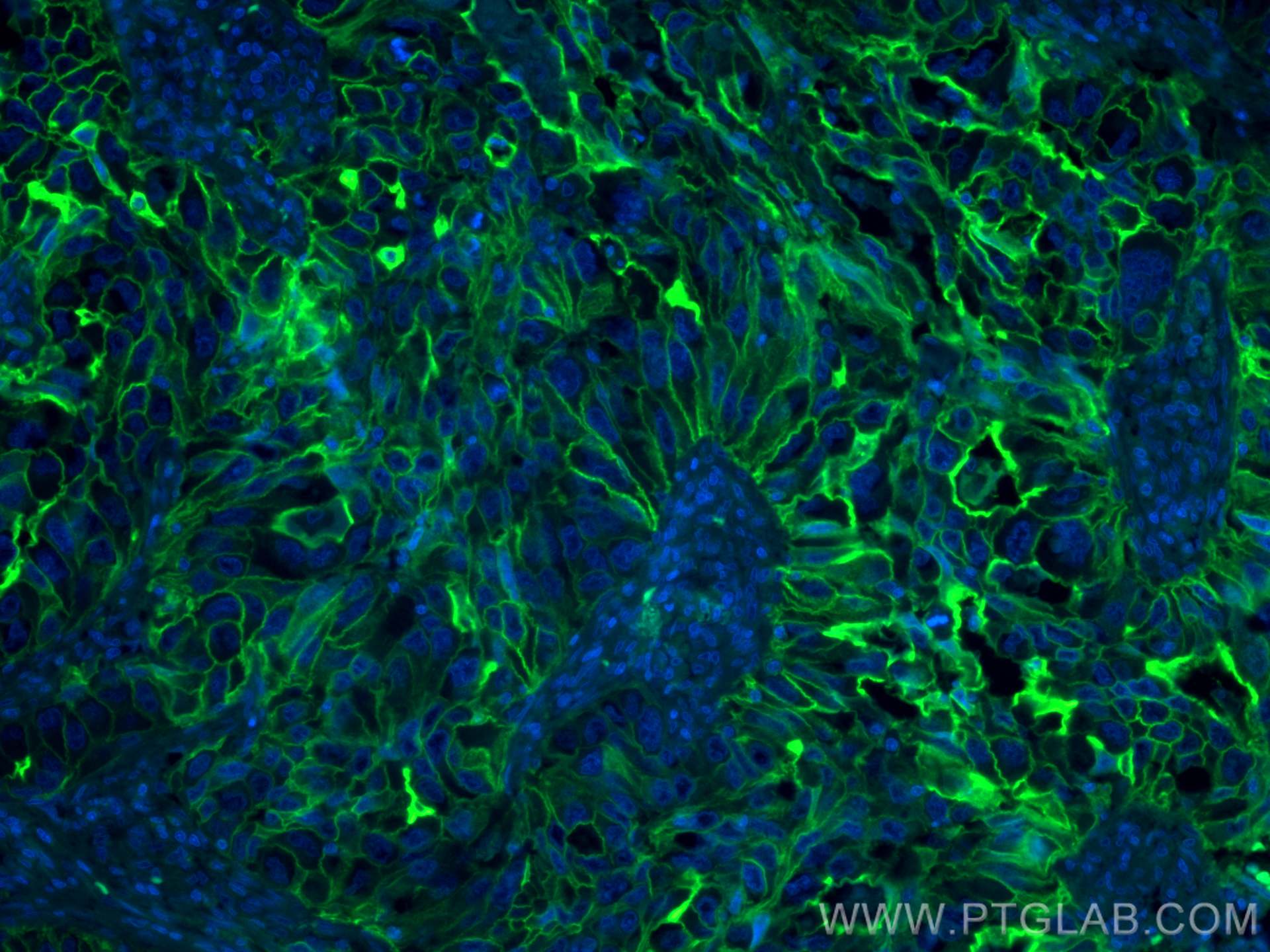 Immunofluorescence (IF) / fluorescent staining of human lung cancer tissue using FITC-conjugated ICAM-1/CD54 Monoclonal antibody (FITC-60299)