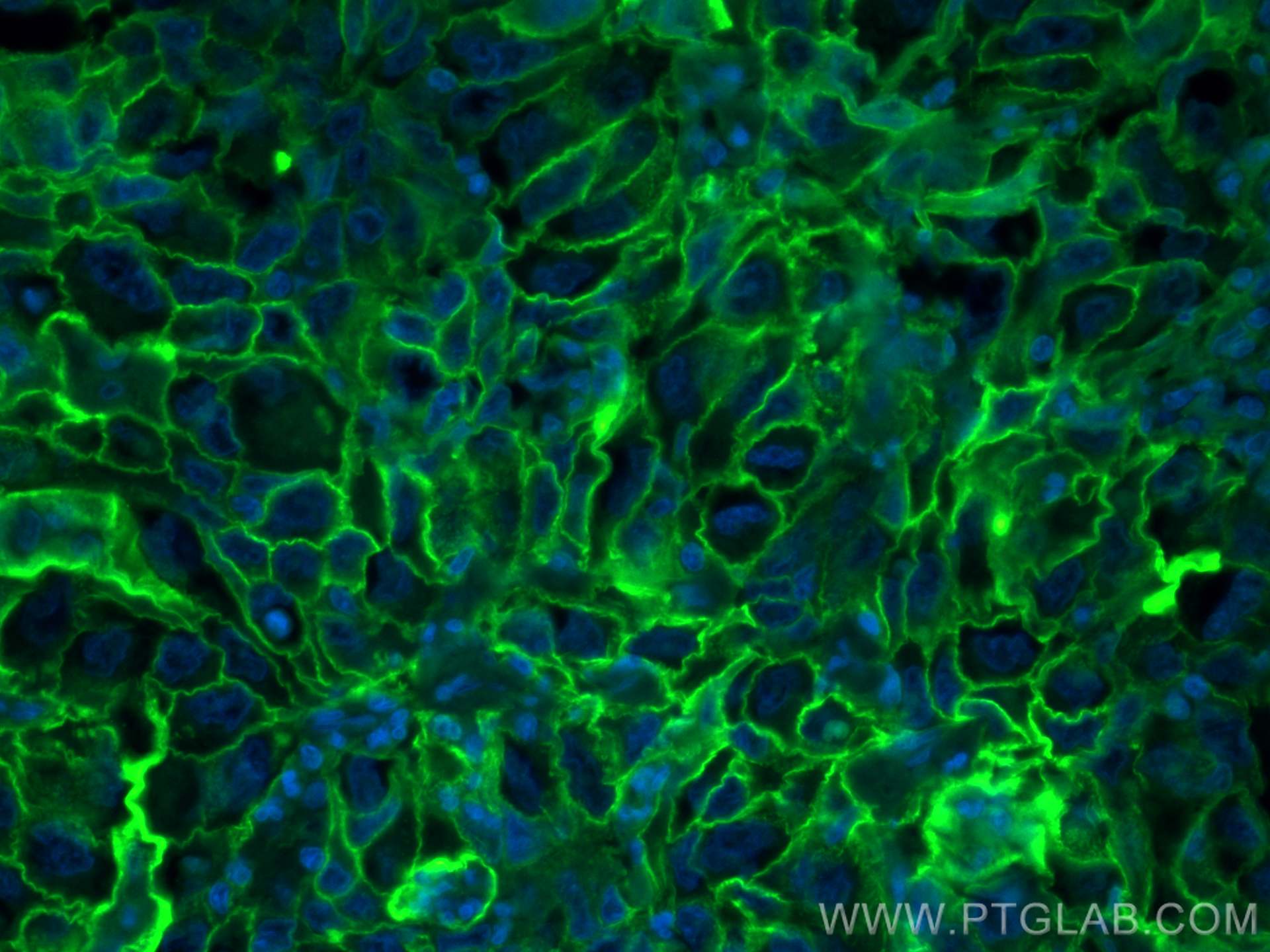 Immunofluorescence (IF) / fluorescent staining of human lung cancer tissue using FITC-conjugated ICAM-1/CD54 Monoclonal antibody (FITC-60299)