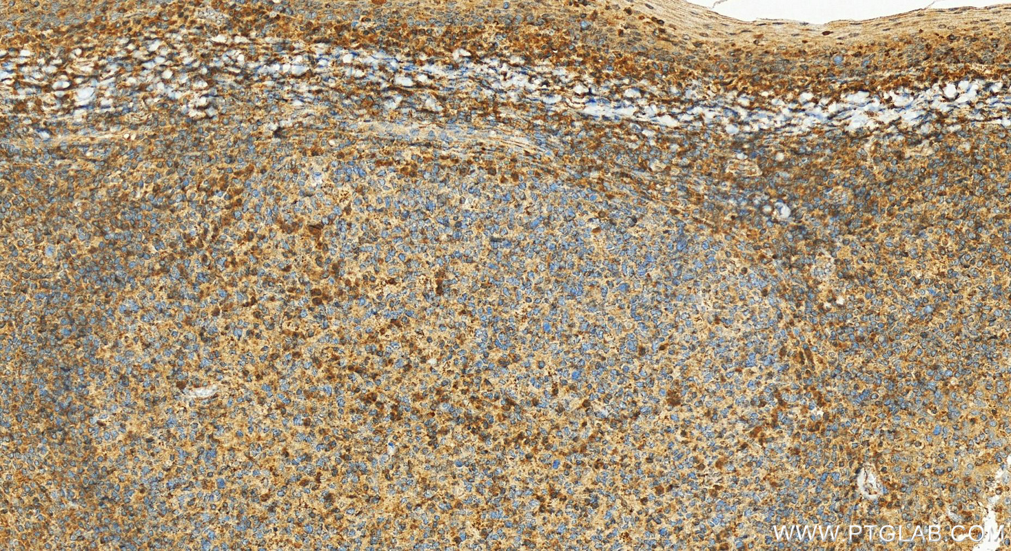 Immunohistochemistry (IHC) staining of human tonsillitis tissue using ICOS Polyclonal antibody (13338-1-AP)