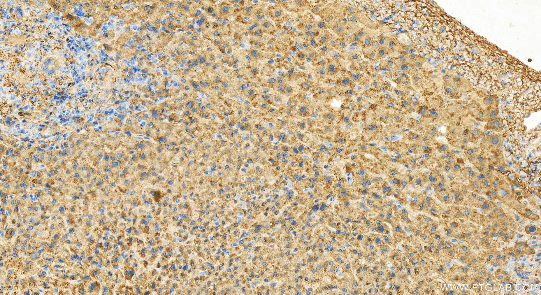 Immunohistochemistry (IHC) staining of human intrahepatic cholangiocarcinoma tissue using IDH1 Polyclonal antibody (12332-1-AP)