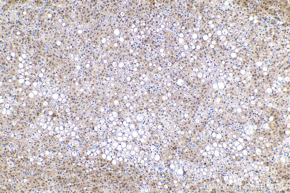 Immunohistochemistry (IHC) staining of human liver cancer tissue using IDH1 Monoclonal antibody (66197-1-Ig)