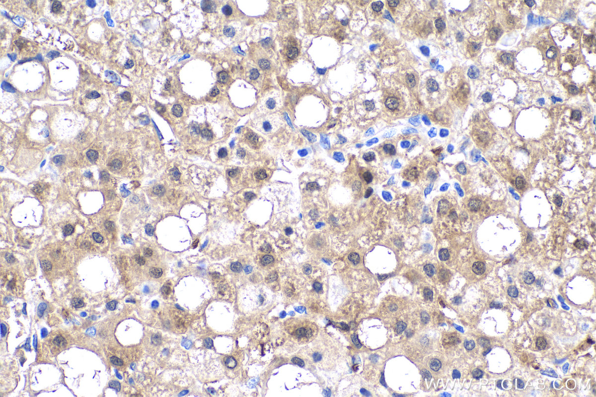 Immunohistochemistry (IHC) staining of human liver cancer tissue using IDH1 Monoclonal antibody (66197-1-Ig)