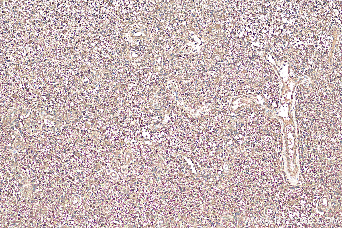 Immunohistochemistry (IHC) staining of human gliomas tissue using IDH1 Recombinant antibody (81176-1-RR)