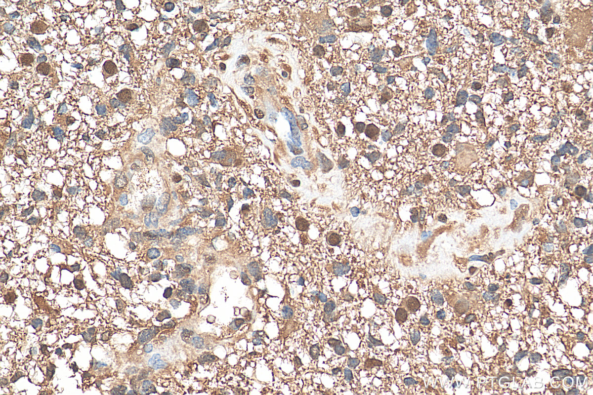 Immunohistochemistry (IHC) staining of human gliomas tissue using IDH1 Recombinant antibody (81176-1-RR)