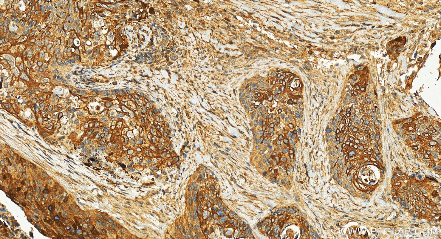 Immunohistochemistry (IHC) staining of human cervical squamous cancer tissue using IDO1 Polyclonal antibody (13268-1-AP)