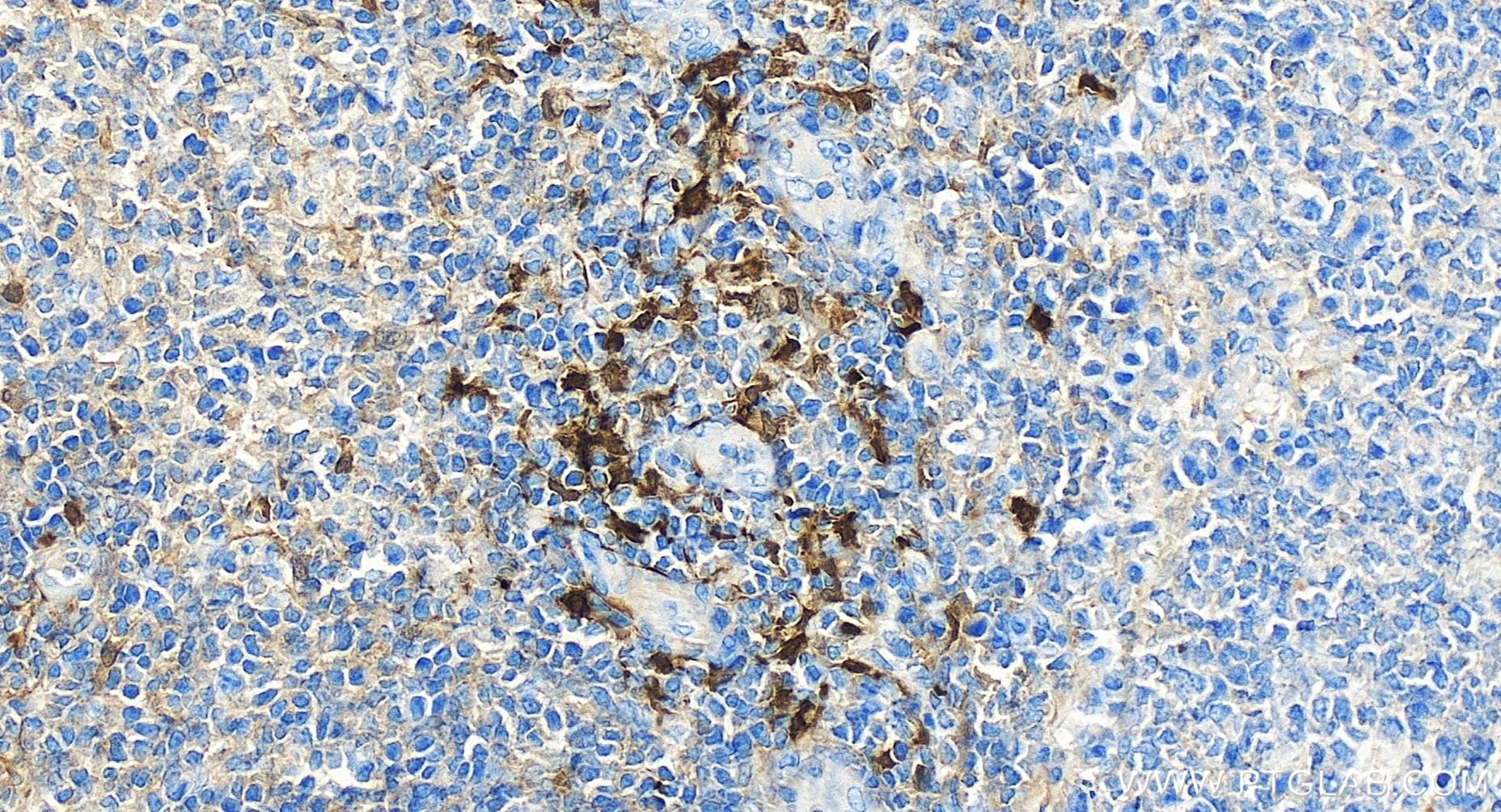 Immunohistochemistry (IHC) staining of human tonsillitis tissue using IDO1 Recombinant antibody (84063-3-RR)