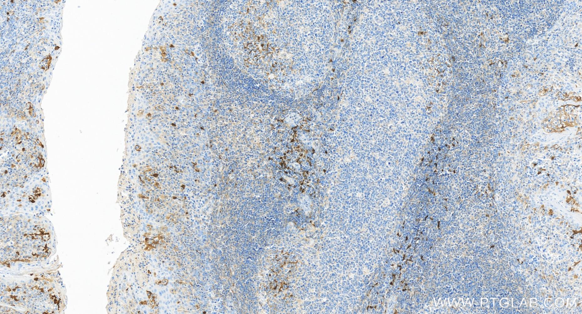 Immunohistochemistry (IHC) staining of human tonsillitis tissue using IDO1 Recombinant antibody (84063-3-RR)