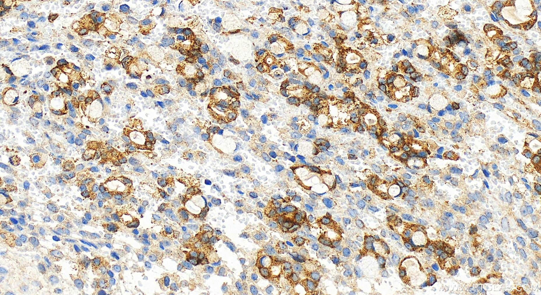 Immunohistochemistry (IHC) staining of human ovary cancer tissue using IFI35 Recombinant antibody (83160-4-RR)