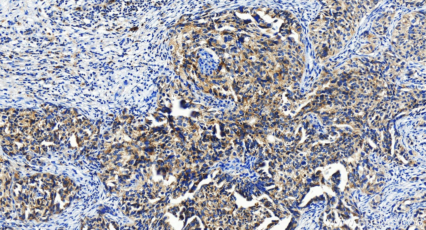 Immunohistochemistry (IHC) staining of human ovary cancer tissue using IFIH1-Specific Polyclonal antibody (16879-1-AP)