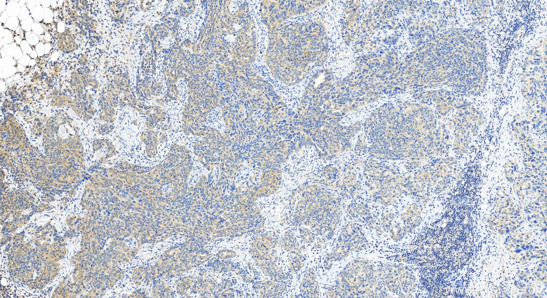 Immunohistochemistry (IHC) staining of human ovary cancer tissue using IFIT1 Polyclonal antibody (29897-1-AP)