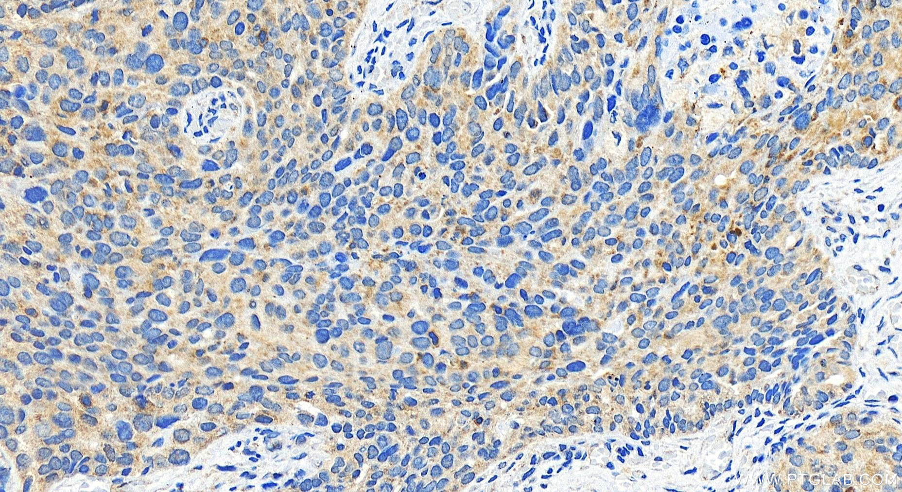 Immunohistochemistry (IHC) staining of human ovary cancer tissue using IFIT1 Polyclonal antibody (29897-1-AP)