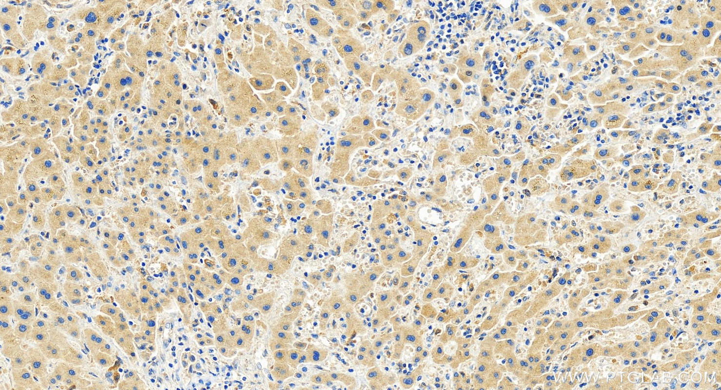 Immunohistochemistry (IHC) staining of human intrahepatic cholangiocarcinoma tissue using IFIT1 Recombinant antibody (83423-1-RR)