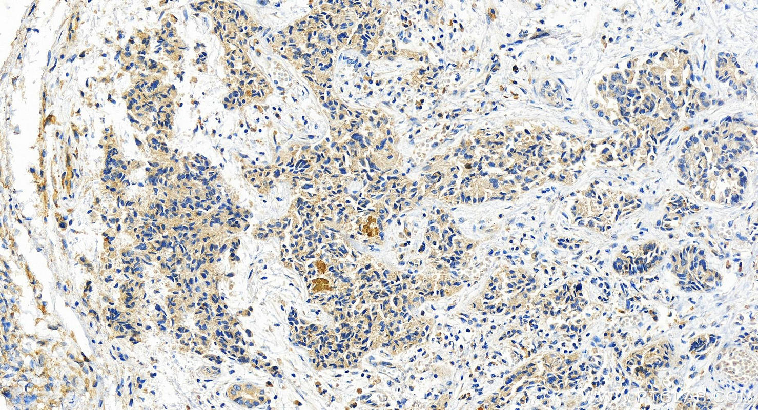 Immunohistochemistry (IHC) staining of human intrahepatic cholangiocarcinoma tissue using IFIT1 Recombinant antibody (83423-1-RR)