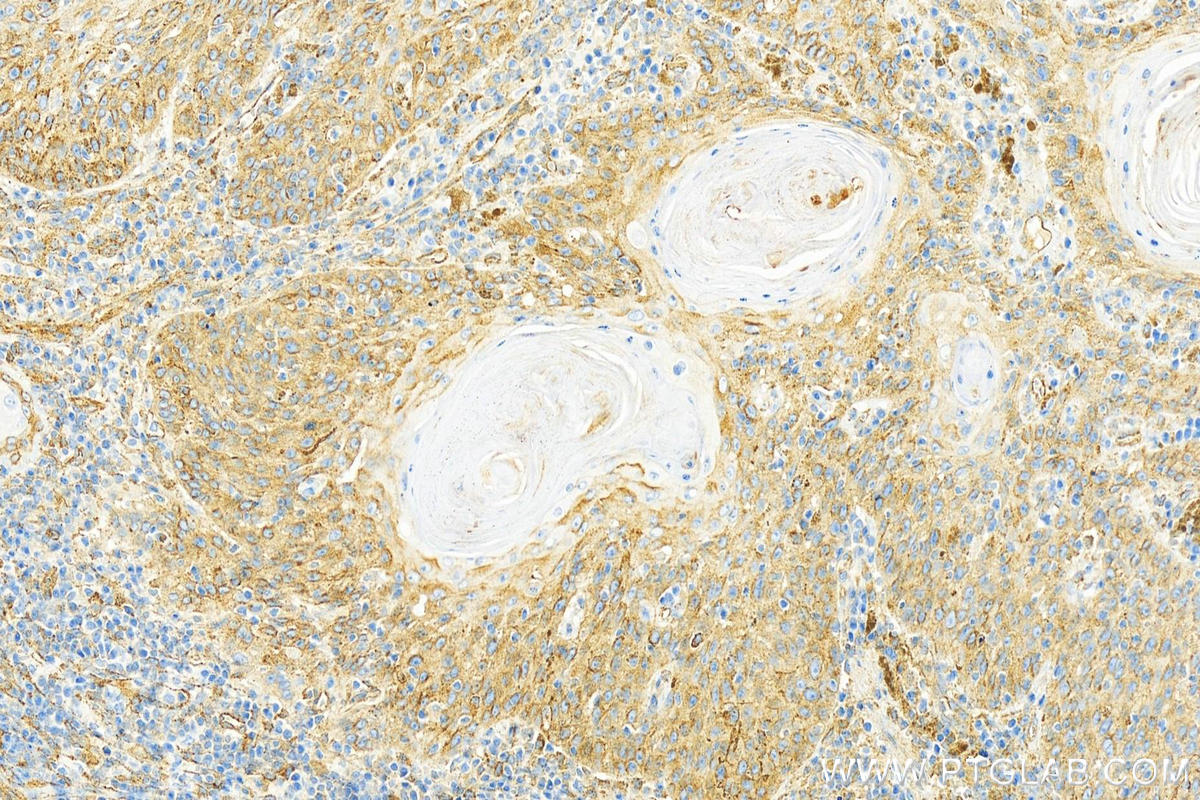 Immunohistochemistry (IHC) staining of human skin cancer tissue using IFITM3 Polyclonal antibody (11714-1-AP)