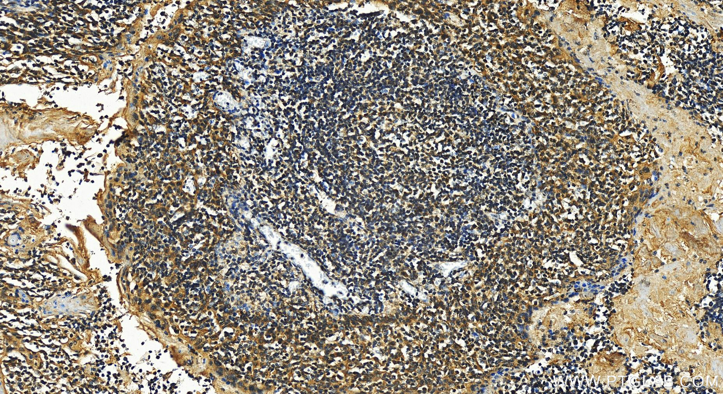 Immunohistochemistry (IHC) staining of human tonsillitis tissue using IFN Gamma Polyclonal antibody (15365-1-AP)