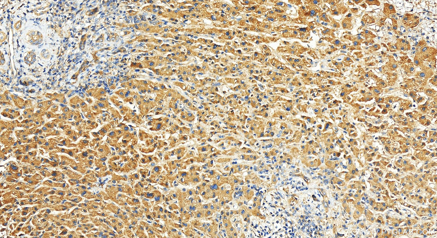 Immunohistochemistry (IHC) staining of human intrahepatic cholangiocarcinoma tissue using IFRD1 Polyclonal antibody (12939-1-AP)