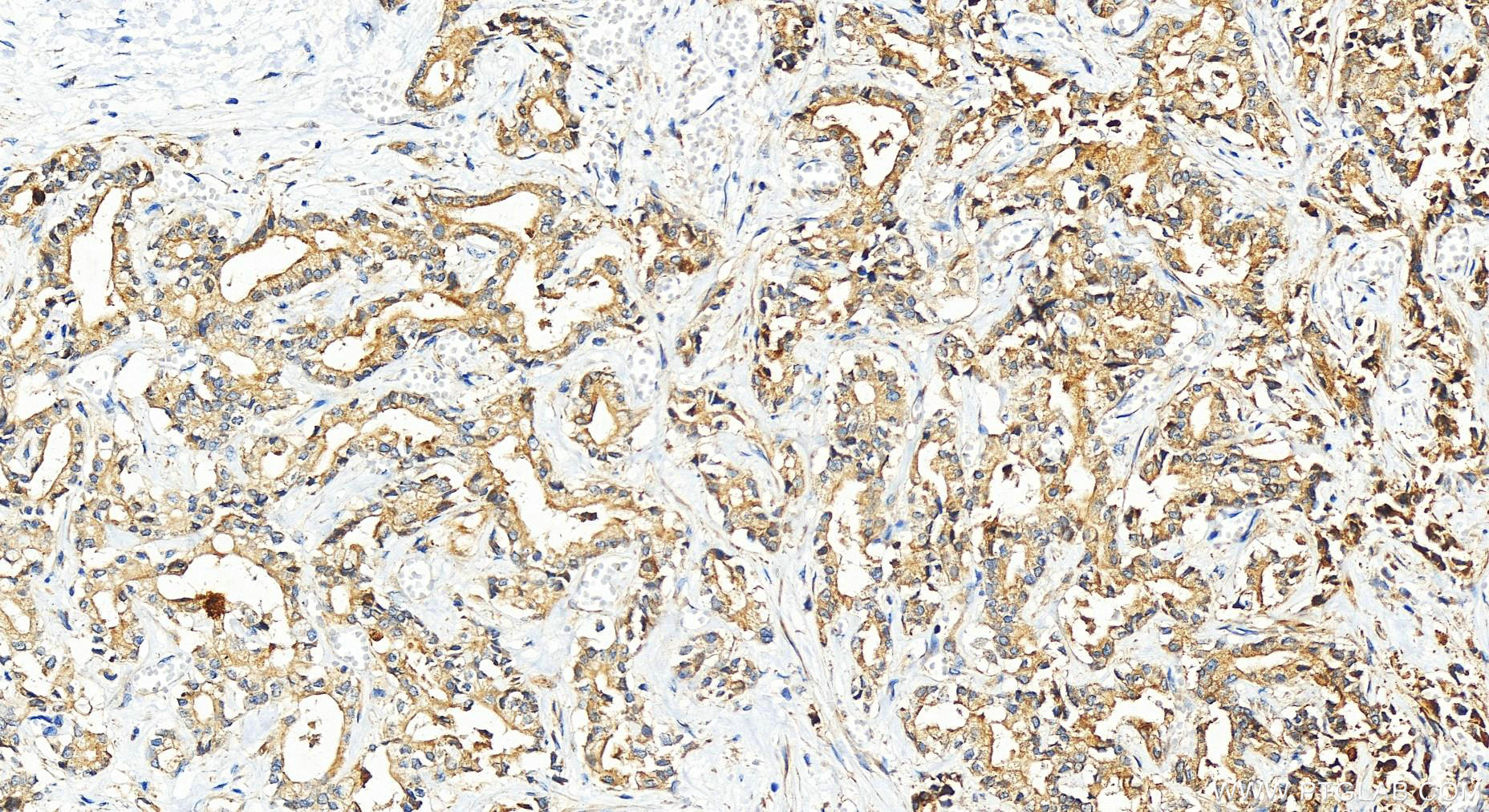 Immunohistochemistry (IHC) staining of human intrahepatic cholangiocarcinoma tissue using IFRD1 Polyclonal antibody (12939-1-AP)