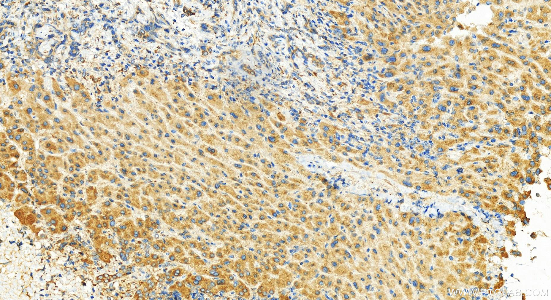 Immunohistochemistry (IHC) staining of human intrahepatic cholangiocarcinoma tissue using IFRD2 Polyclonal antibody (10649-1-AP)