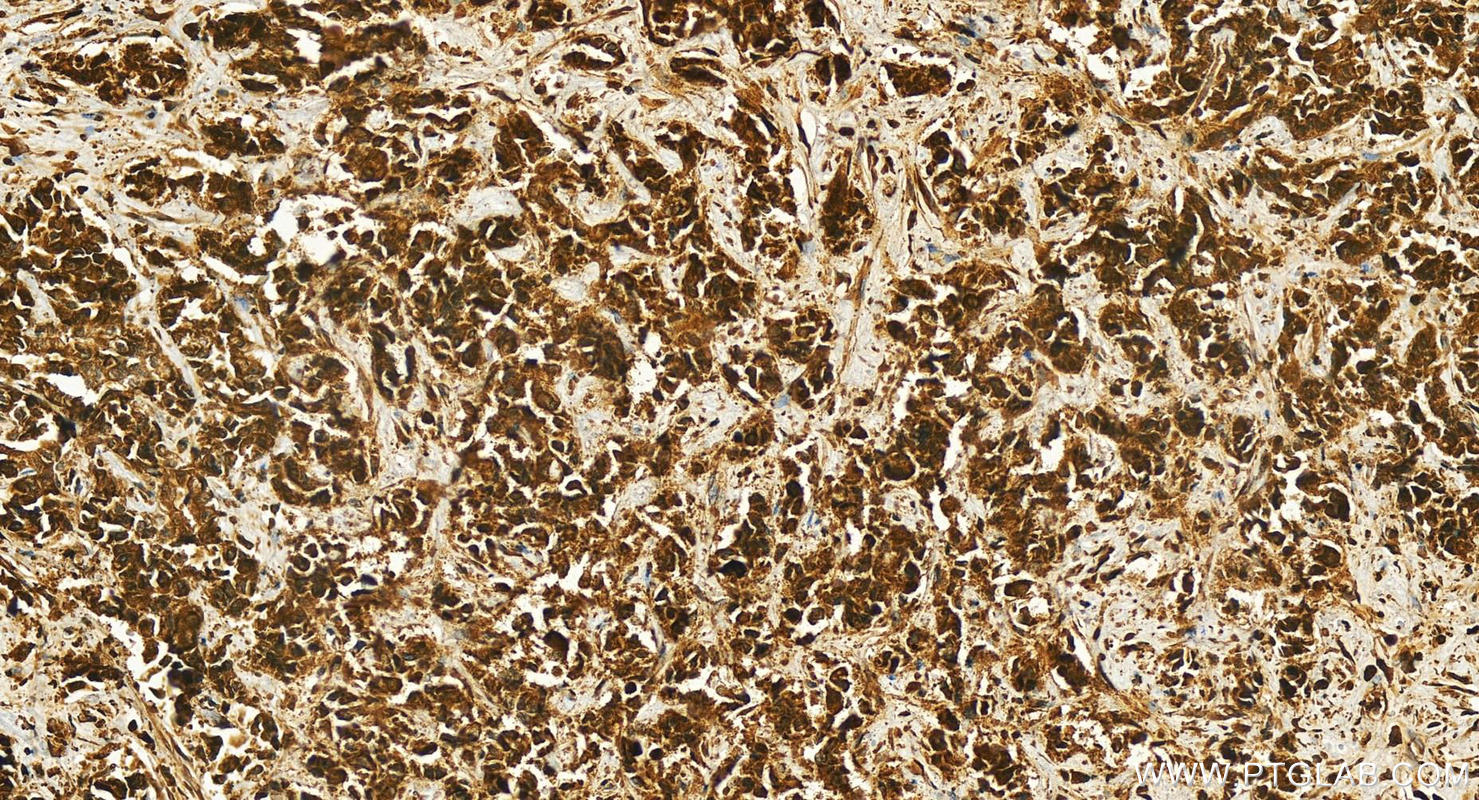 Immunohistochemistry (IHC) staining of human intrahepatic cholangiocarcinoma tissue using IFRD2 Polyclonal antibody (26952-1-AP)