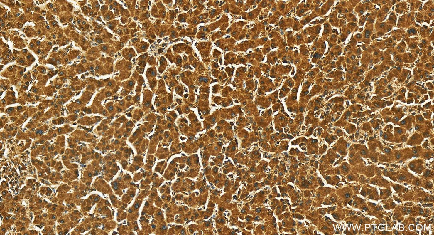 Immunohistochemistry (IHC) staining of human intrahepatic cholangiocarcinoma tissue using IFRD2 Polyclonal antibody (26952-1-AP)