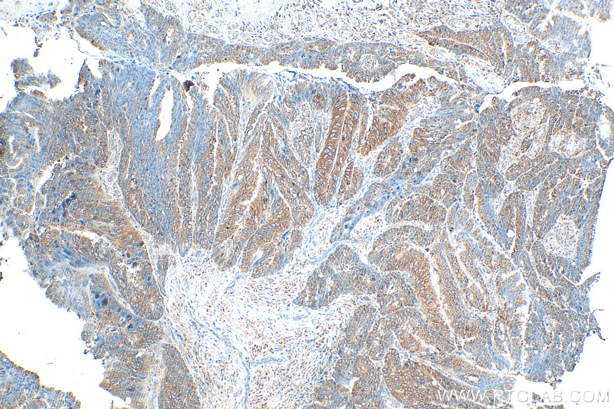 Immunohistochemistry (IHC) staining of human colon cancer tissue using IGF2BP3 Polyclonal antibody (14642-1-AP)