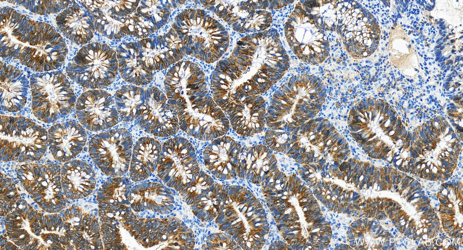 Immunohistochemistry (IHC) staining of human colon cancer tissue using IGF2BP3 Recombinant antibody (81805-1-RR)