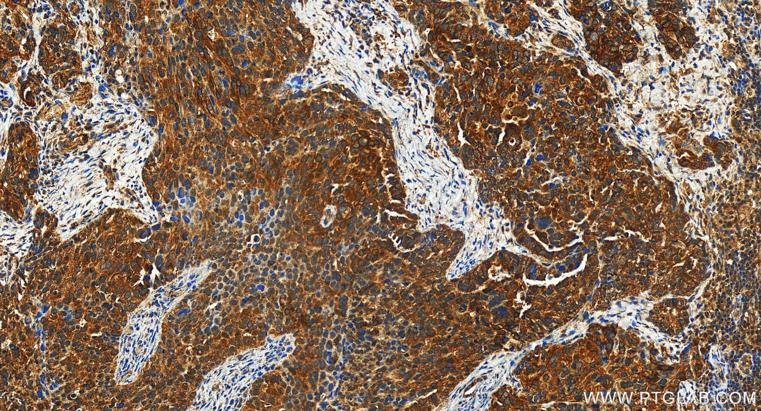 Immunohistochemistry (IHC) staining of human ovary cancer tissue using IGFBP2 Polyclonal antibody (31248-1-AP)