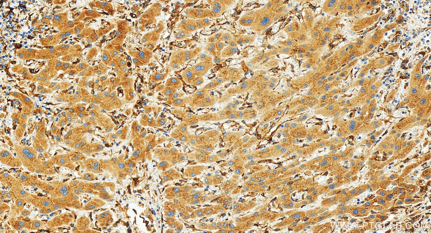 Immunohistochemistry (IHC) staining of human intrahepatic cholangiocarcinoma tissue using IGFBP4 Recombinant antibody (83200-3-RR)