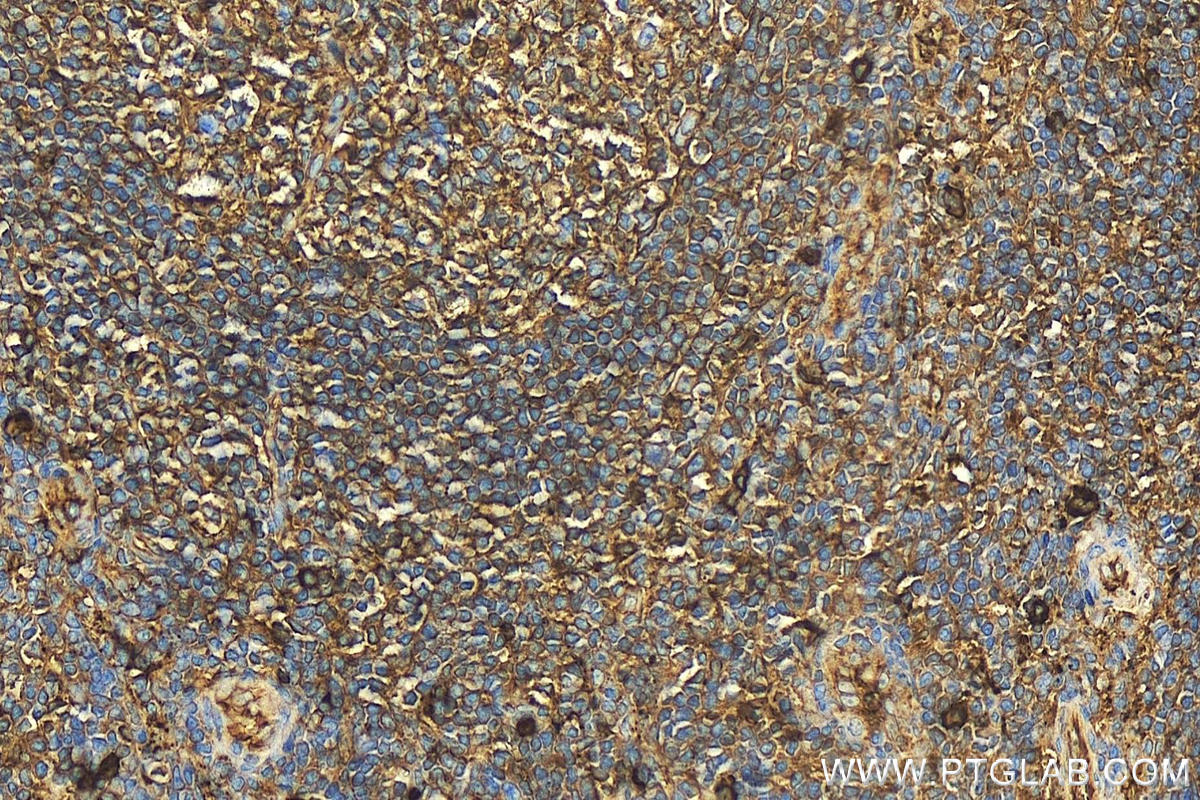 Immunohistochemistry (IHC) staining of human tonsillitis tissue using Human IgA Heavy Chain Polyclonal antibody (11449-1-AP)