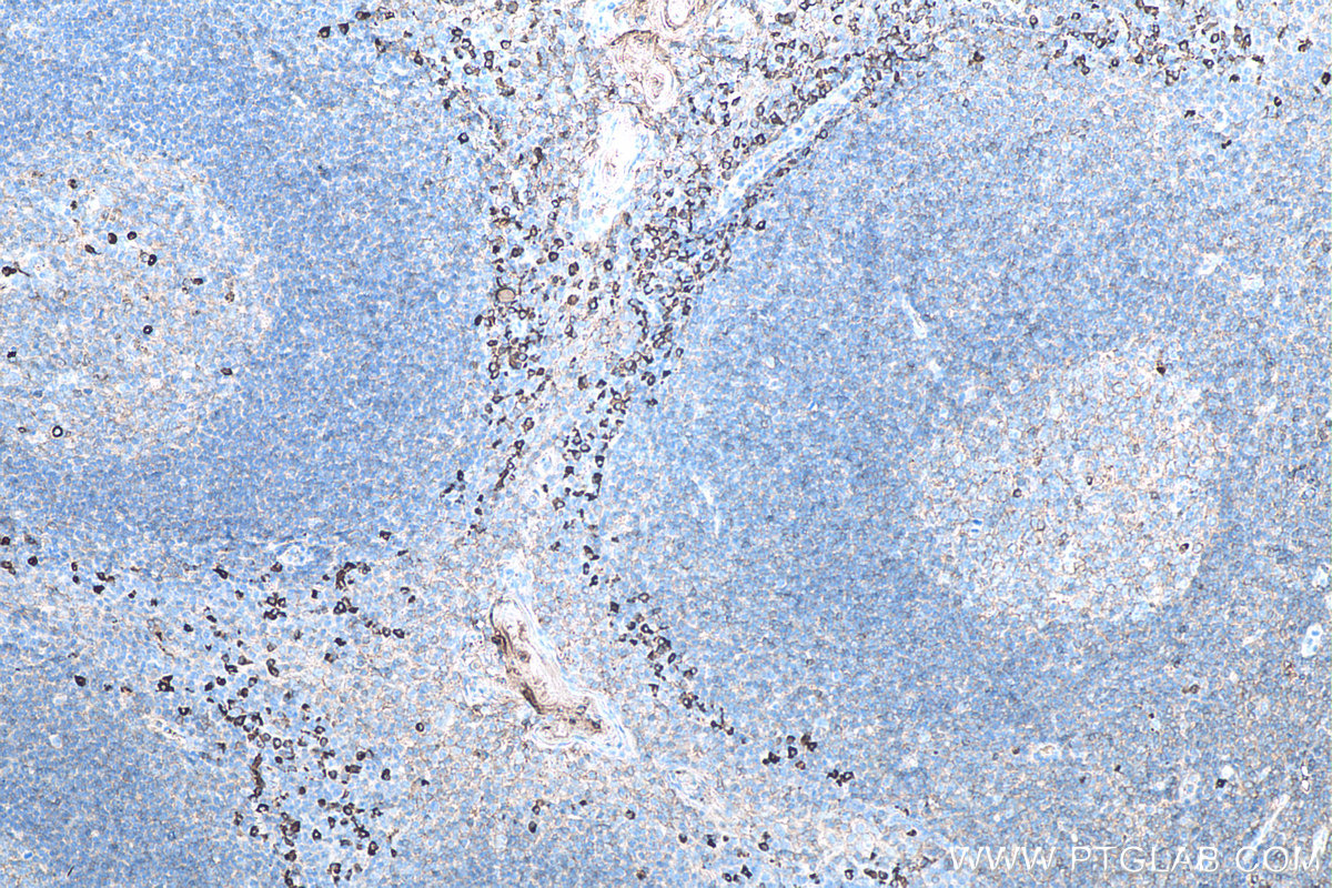 Immunohistochemistry (IHC) staining of human tonsillitis tissue using Human IgA Monoclonal antibody (60099-1-Ig)