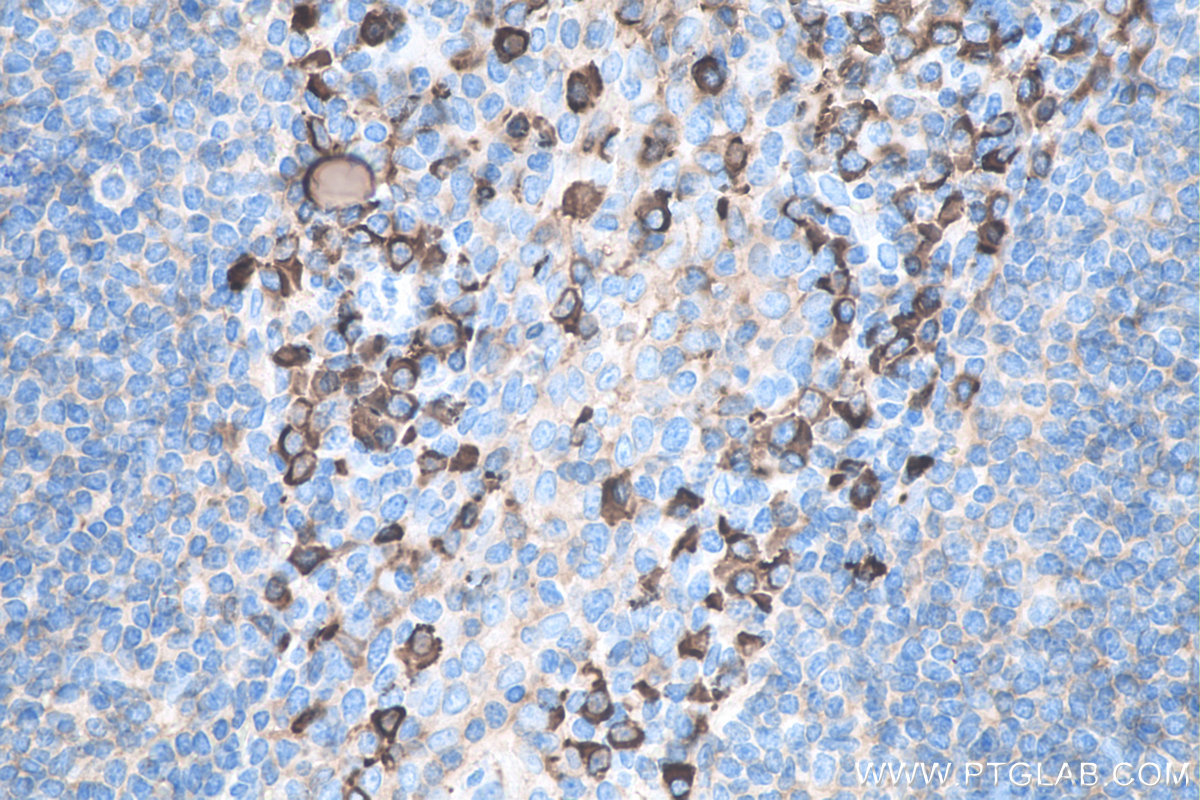 Immunohistochemistry (IHC) staining of human tonsillitis tissue using Human IgA Monoclonal antibody (60099-1-Ig)