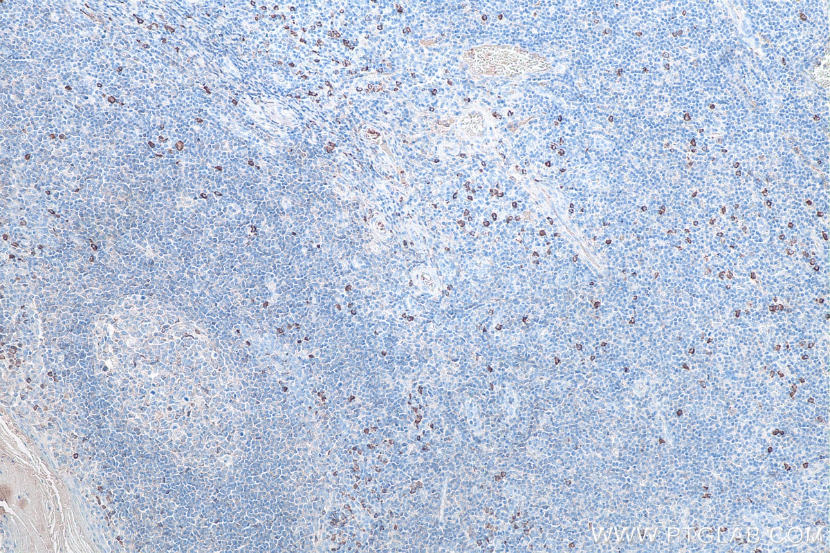 Immunohistochemistry (IHC) staining of human tonsillitis tissue using Human IgA Monoclonal antibody (60099-1-Ig)