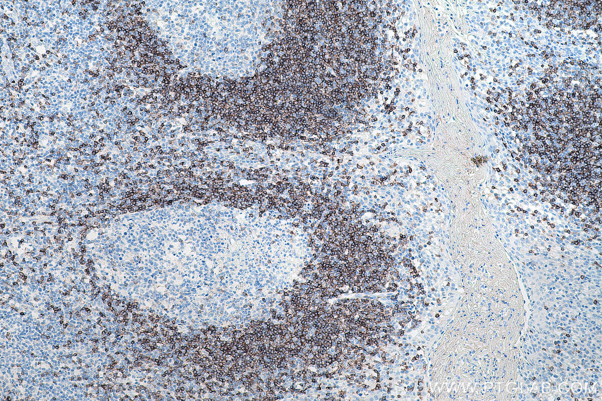 Immunohistochemistry (IHC) staining of human tonsillitis tissue using human IgD Monoclonal antibody (67538-1-Ig)