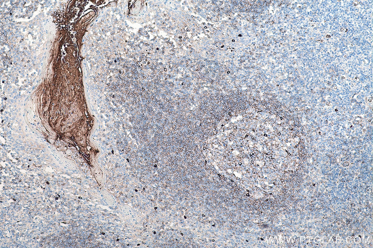 Immunohistochemistry (IHC) staining of human tonsillitis tissue using human IgM Monoclonal antibody (66484-1-Ig)
