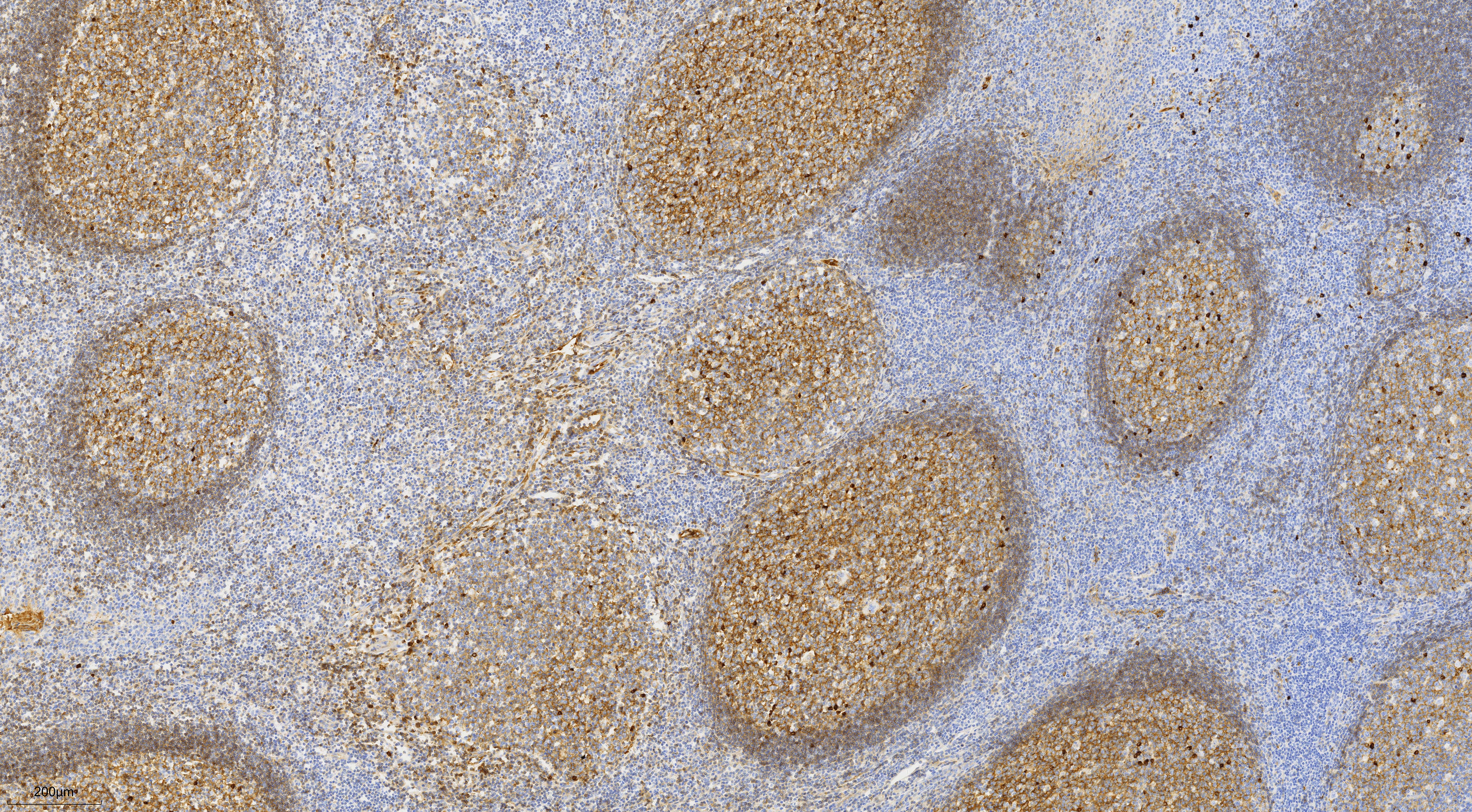 Immunohistochemistry (IHC) staining of human tonsillitis tissue using human IgM Monoclonal antibody (66484-1-Ig)