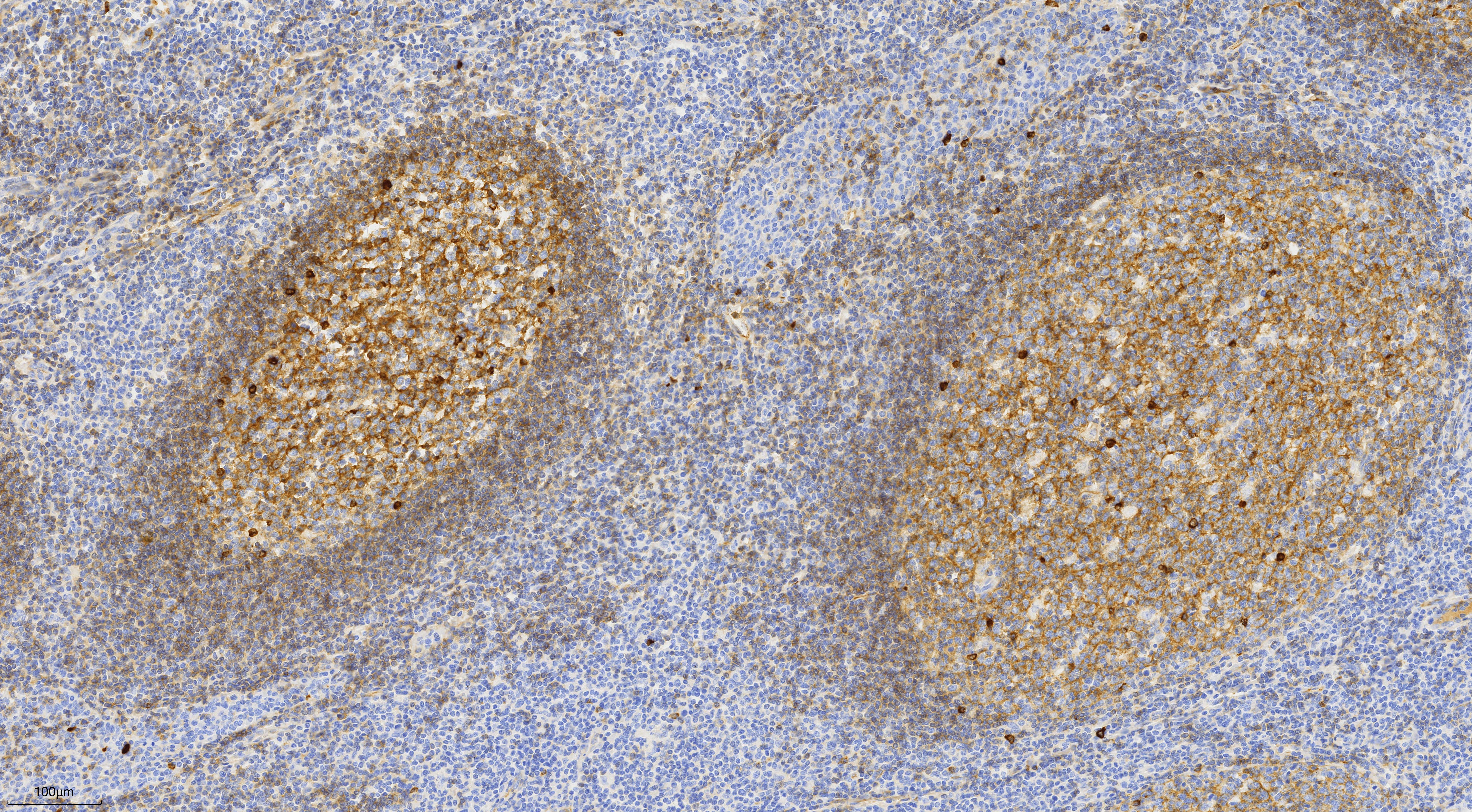 Immunohistochemistry (IHC) staining of human tonsillitis tissue using human IgM Monoclonal antibody (66484-1-Ig)