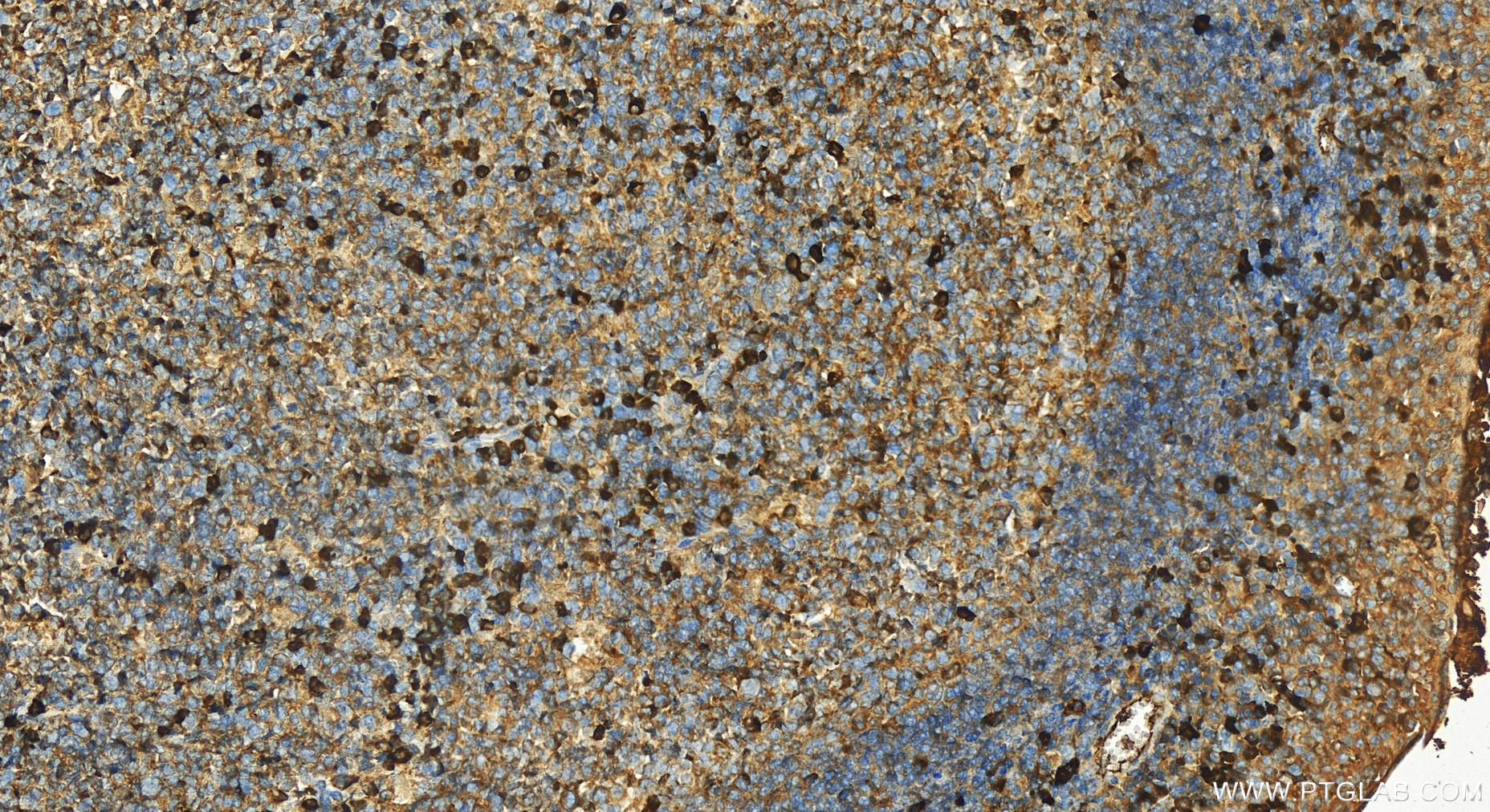 Immunohistochemistry (IHC) staining of human tonsillitis tissue using IGJ Polyclonal antibody (13688-1-AP)