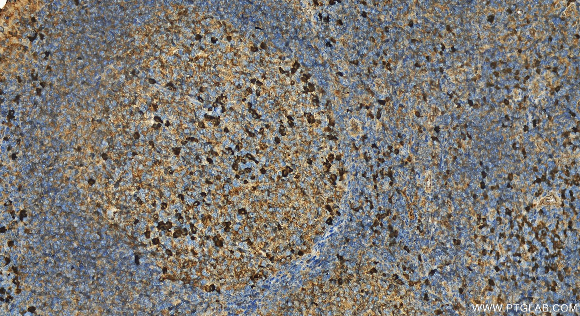 Immunohistochemistry (IHC) staining of human tonsillitis tissue using IGJ Polyclonal antibody (13688-1-AP)