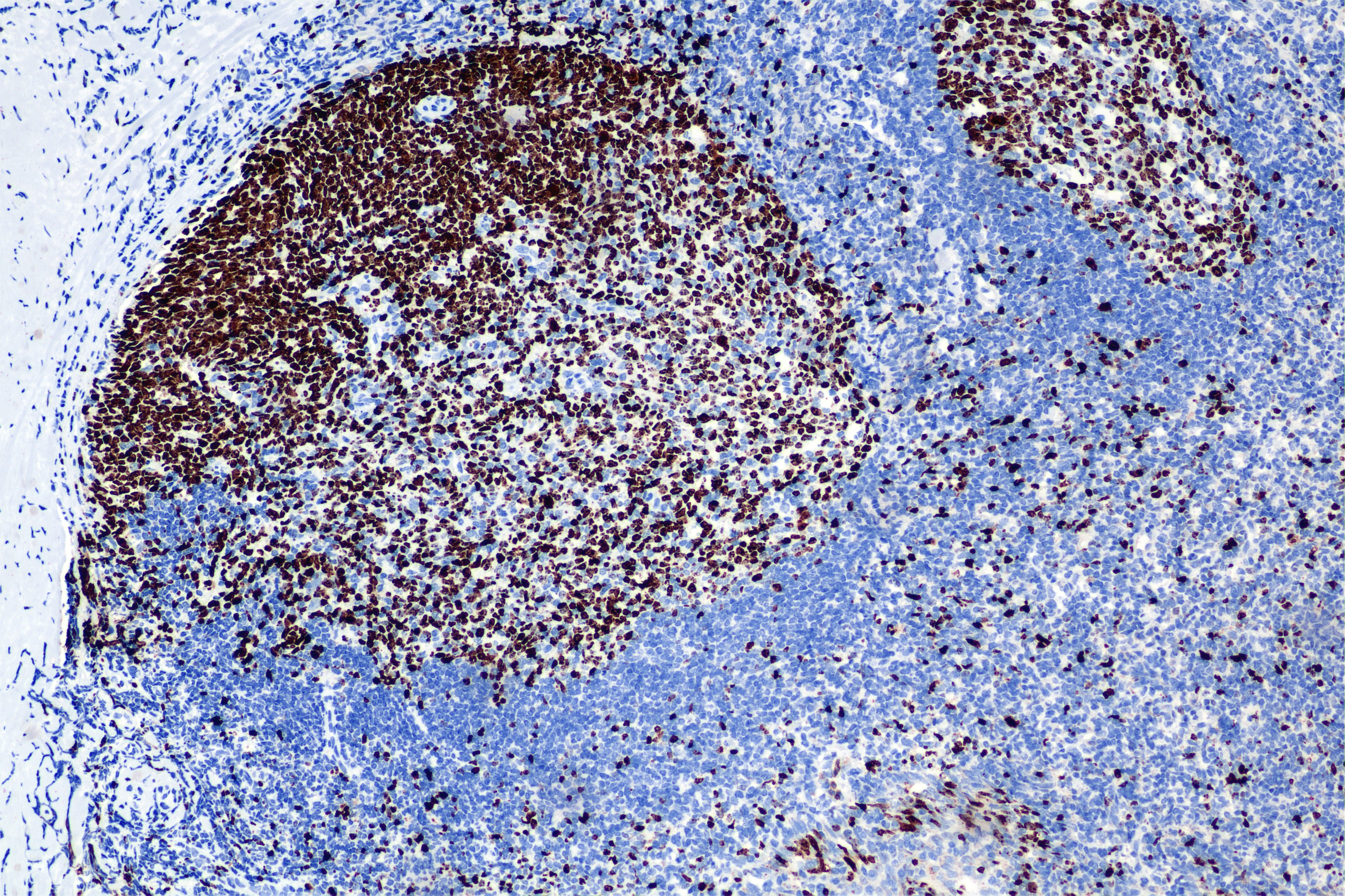 Immunohistochemical analysis of paraffin-embedded mouse heart tissue slide using HRP-PF00030 (HRP Streptavidin) at dilution of 1:500 (under 20X lens). Heat mediated antigen retrieval with Tris-EDTA buffer (pH 9.0).
Primary antibody is Biotin-conjugated Ki-67 Recombinant monoclonal antibody. Immunohistochemical analysis of paraffin-embedded mouse heart tissue slide using HRP-PF00030 (HRP Streptavidin) at dilution of 1:500 (under 20X lens). Heat mediated antigen retrieval with Tris-EDTA buffer (pH 9.0).
Primary antibody is Biotin-conjugated Ki-67 Recombinant monoclonal antibody.