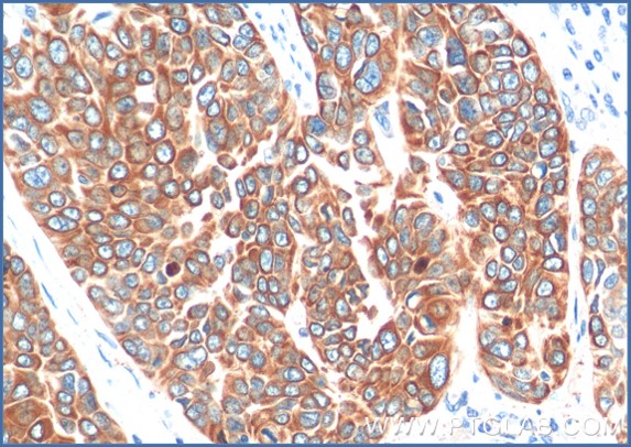 Immunohistochemical analysis of paraffin-embedded human oesophagus cancer tissue slide using anti-Cytokeratin 5 antibody (66727-1-Ig) labeled with FlexAble HRP Antibody Labeling Kit for Mouse IgG1 (KFA025).  Antibody used at dilution of 1:400 under 10x & 40x lens. Heat mediated antigen retrieval performed with Tris-EDTA buffer (pH 9.0) and DAB substrate was used for detection.