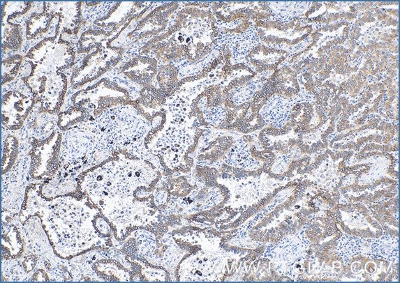 Immunohistochemical analysis of paraffin-embedded  human lung cancer tissue slide using anti-CK7 antibody (66483-1-Ig) labeled with FlexAble Biotin Antibody Labeling Kit for Mouse IgG2a (KFA047) and used at a dilution of 1:800 (under 10x lens). Streptavidin Poly-HRP and DAB substrate was used for detection. Heat mediated antigen retrieval performed with Tris-EDTA buffer (pH 9.0).