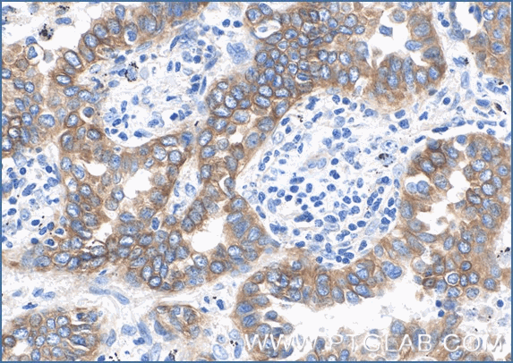Immunohistochemical analysis of paraffin-embedded  human lung cancer tissue slide using anti-CK7 antibody (66483-1-Ig) labeled with FlexAble Biotin Antibody Labeling Kit for Mouse IgG2a (KFA047) and used at a dilution of 1:800 (under 40x lens). Streptavidin Poly-HRP and DAB substrate was used for detection. Heat mediated antigen retrieval performed with Tris-EDTA buffer (pH 9.0).